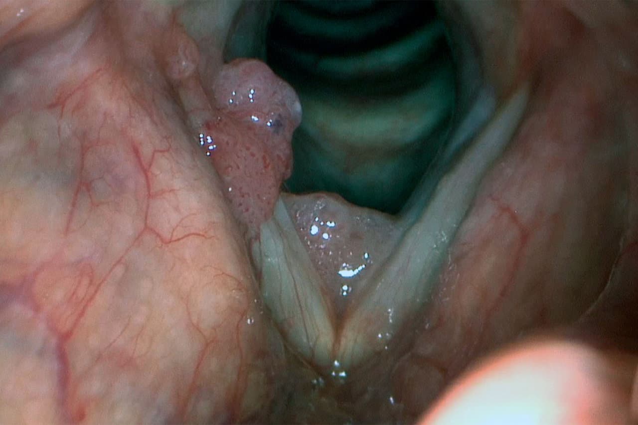 ларингоскопія рак голосових зв'язок